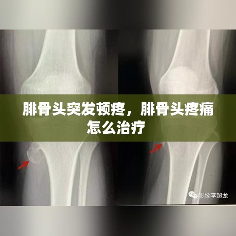 腓骨头突发顿疼，腓骨头疼痛怎么治疗 